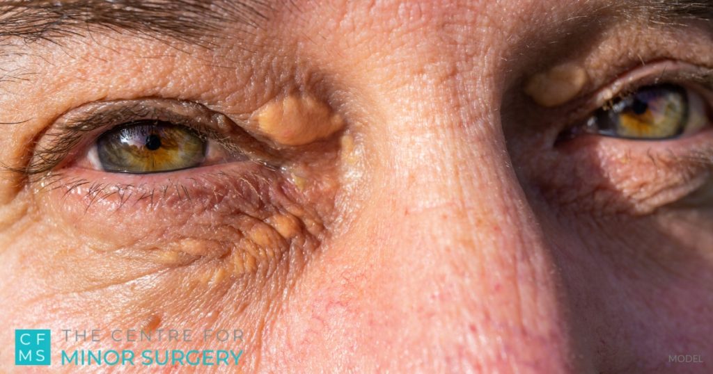 Xanthelasma Removal: Say Goodbye to Yellow Eyelid Bumps – Centre for Minor  Surgery
