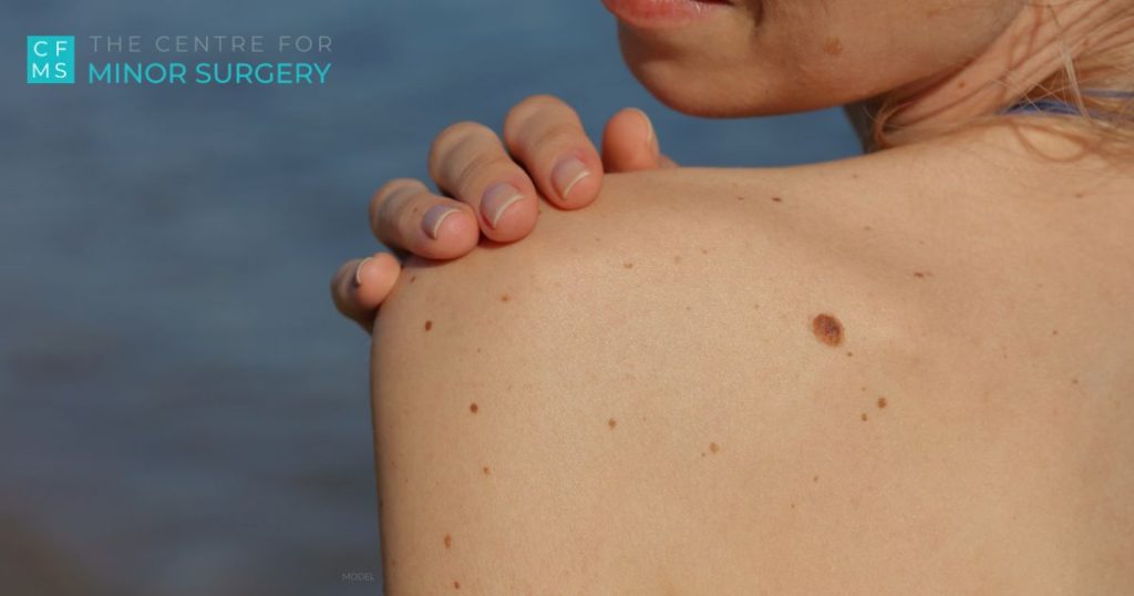 A woman (model) looks at a mole on her upper shoulder