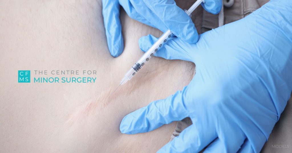 a person getting a steroid injection on their stomach (MODEL) for their keloid scar.