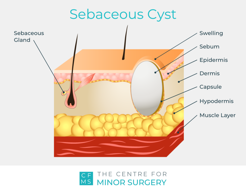 Sebaceous Cyst Instagraphic 